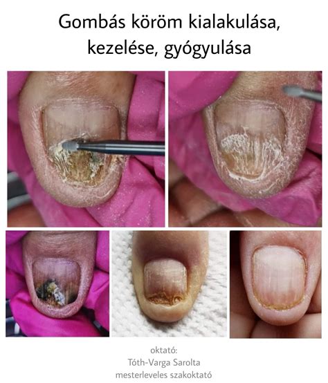 A köröm gombás fertőzésének mikroszkópos képe