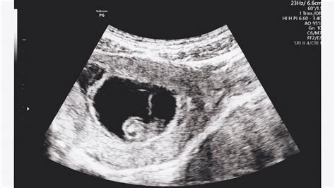 A 9 hetes magzat fejlődése