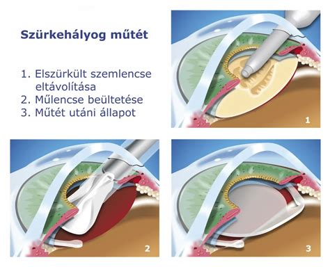A lombikbébi eljárás lépései