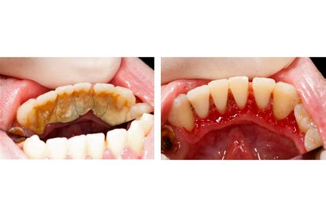 fogkő eltávolítása