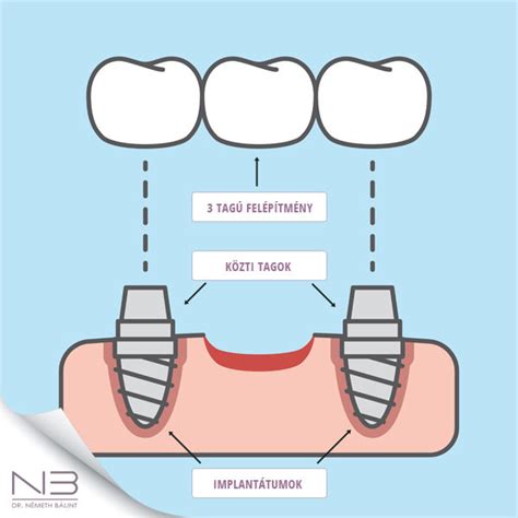fogpótlás típusai