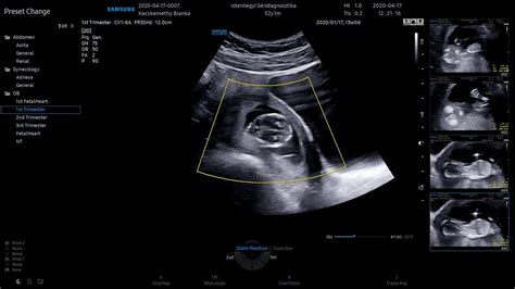 genetikai ultrahang 12. hét
