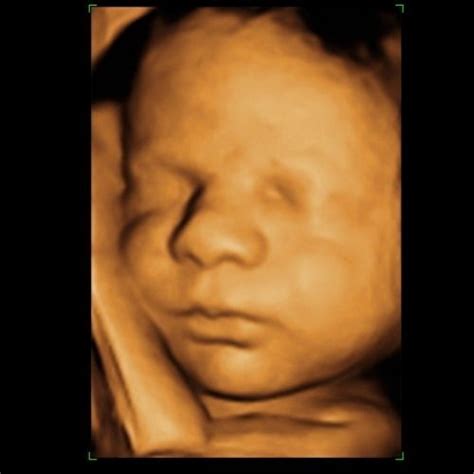 3D ultrahang kismama