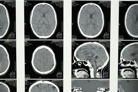 Magzati agy fejlődési rendellenességeinek feltárása MRI segítségével