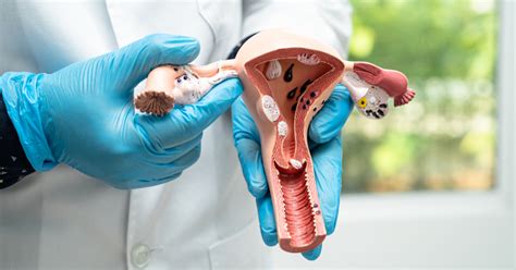 Infografika a petefészek ciszta lehetséges szövődményeiről