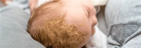 Koszmó újszülött fejbőrén