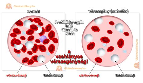 Vashiányos vérszegénység tünetei