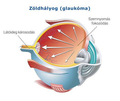Glaukóma kezelése szemcseppel