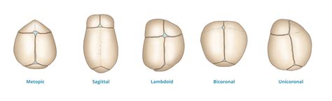 Sémája a craniosynostosis típusairól