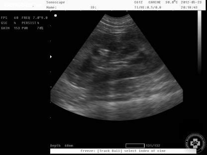 Vesemedence tágulat ultrahang képe