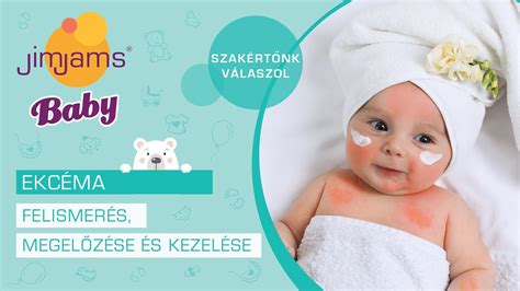 Csecsemőkori ekcéma