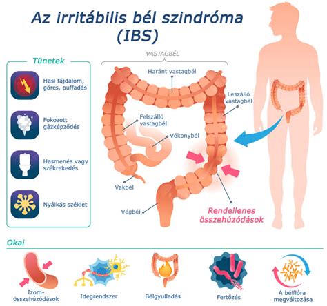 Infografika az IBS tüneteiről