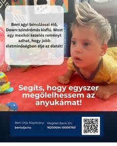 Gyermek Down-szindrómával, aki külső jegyeit mutatja