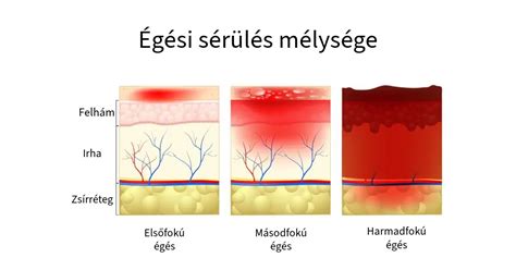 gyermek orvosi ellátása égési sérülés esetén