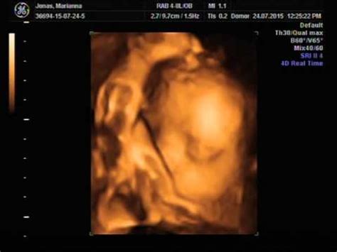 ultrahang kép 29 hetes magzatról