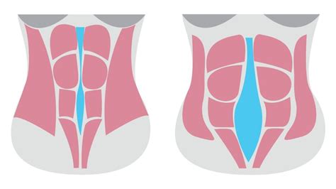 Infografika a szétnyílt hasizom okairól