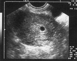 A petezsák ultrahangos képe különböző terhességi hetekben