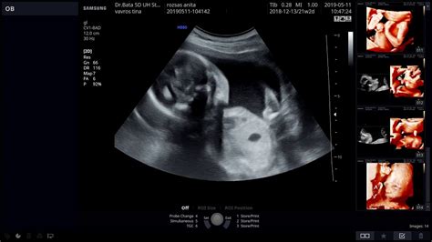 3D ultrahang felvétel a méhről