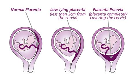 Infografika a placenta praevia kockázati tényezőiről