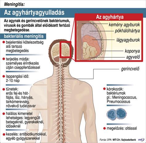 Agyhártyagyulladás tünetei és megelőzése