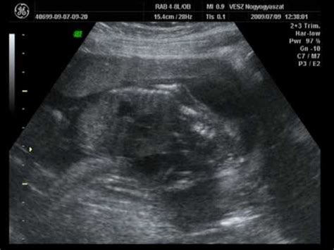 Ultrahang felvétel és CTG görbe