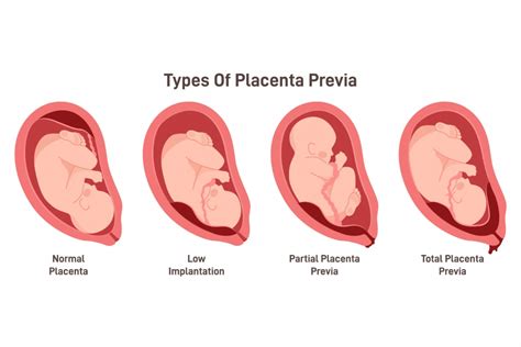 Placenta previa elhelyezkedése