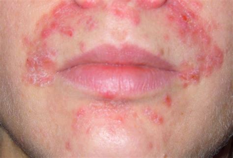 száj körüli bőrgyulladás