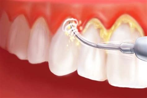 fogkő eltávolítás folyamata