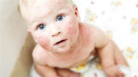 atópiás ekcéma gyermek arcán