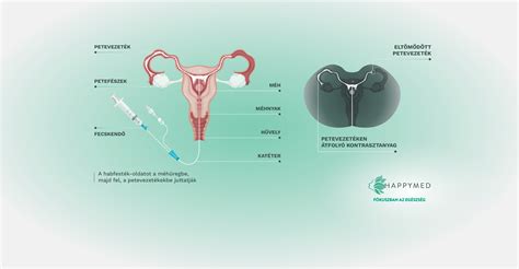 Ultrahangos petefészek vizsgálat