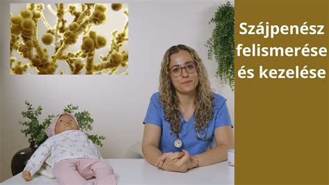 szájpenész csecsemőnél