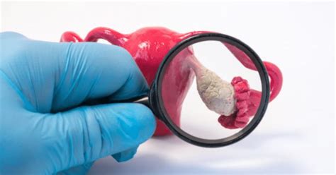 illusztráció a petefészek hiperstimulációs szindrómáról