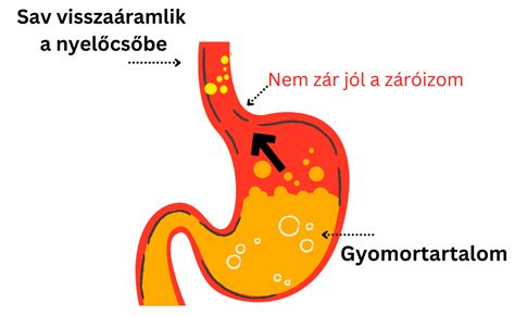 A gyomor és a nyelőcső anatómiája, reflux mechanizmusa