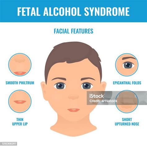 Infografika a magzati alkohol szindróma tüneteiről