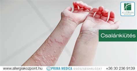 Gyógyszerallergia tünetei
