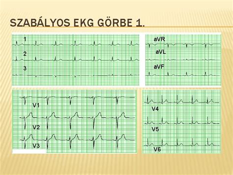 EKG görbe