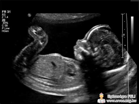 Ultrahang felvétel a méhnyakról és a méhszájról