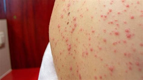 Bárányhimlő kiütések