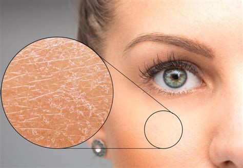 száraz bőr hidratálása