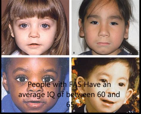 A magzati alkohol szindróma tünetei