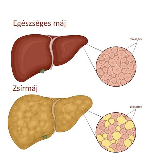 Infografika a zsírmáj kockázati tényezőiről