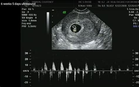 A magzat szívverése ultrahangon