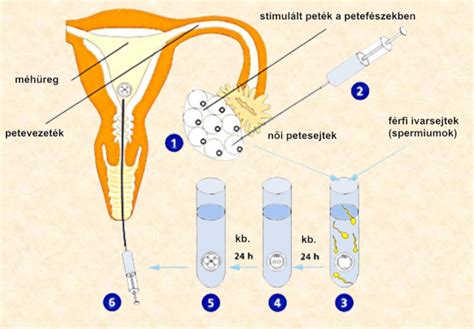hagyományos IVF folyamat
