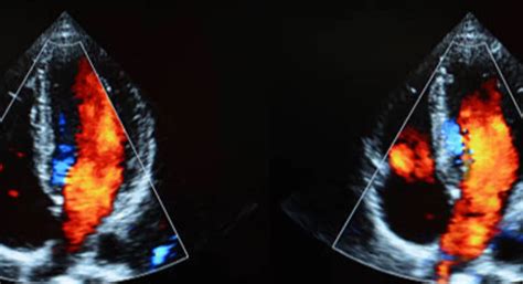 Szívultrahang felvétel