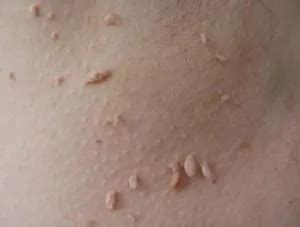 HPV vírus és szemölcsök