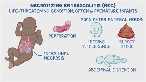 NEC (nekrotizáló enterocolitis) ábra