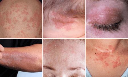 Csecsemő ekcémás bőre