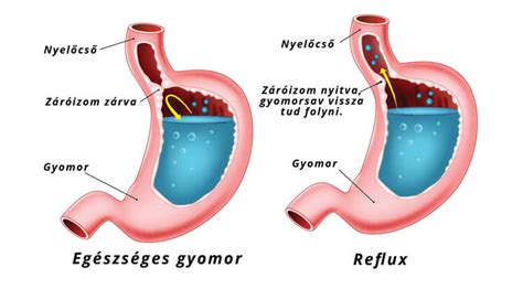 Gyomor-nyelőcső reflux sematikus ábrája