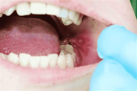 illusztráció a szájüregi fertőzésekről