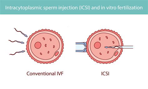 IVF eljárás folyamata